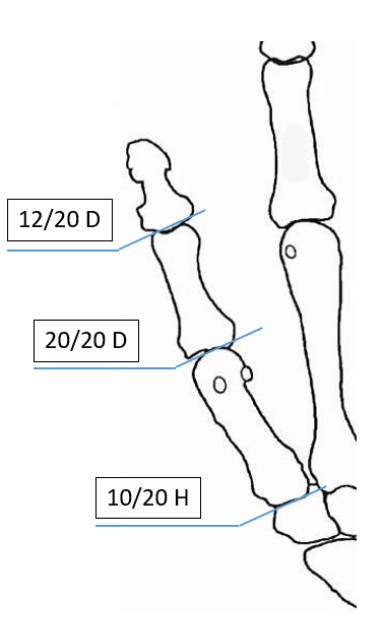 Abbildung 4: Verlustwerte am Daumenstrahl (vgl. Tab. 2)