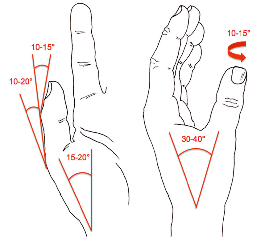 Abbildung 10: Versteifung Daumenstrahl in funktionsgünstiger Stellung (vgl. Tab. 3)