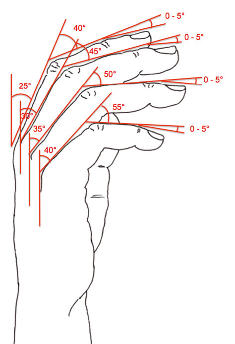Abbildung 12: Versteifungsstellung der Langfingergelenke in funktionsgünstiger Stellung