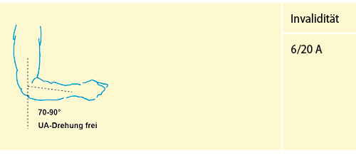 Abbildung 7: Versteifung des Ellenbogengelenks in funktionsgünstiger Stellung (UA-Drehung frei, vgl. Tab. 3)