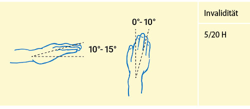 Abbildung 9: Versteifung des Handgelenks in funktionsgünstiger Stellung (vgl. Tab. 3)