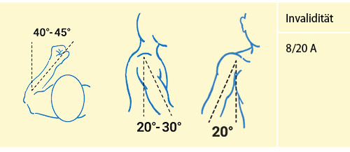 Abbildung 6: Versteifung des Schultergelenks in funktionsgünstiger Stellung (vgl. Tab. 3)