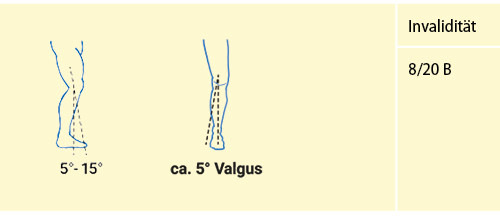Abbildung 17: Versteifung Kniegelenk in gebrauchsgünstiger Stellung (vgl. Tab. 12)