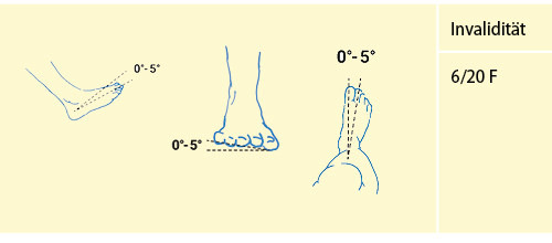 Abbildung 18: Versteifung oberes Sprunggelenk in funktionsgünstiger Stellung (vgl. Tab. 12)