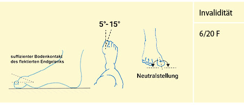 Abbildung 19: Versteifung Großzehe in funktionsgünstiger Stellung (vgl. Tab. 12)