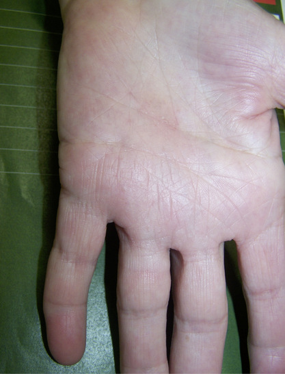 Abbildung 1: Sehr diskrete pathologische Hautveränderungen der linken Hand zentral palmar mit minimaler Rötung und Schuppung nach dyshidrosiformen Bläschen.