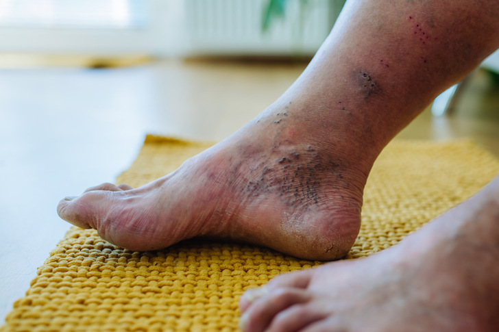 A close-up shot of man's feet with diabetic foot complications, showing his non-healing ulcers, skin discoloration and toe deformities. - © Halfpoint - stock.adobe.com

