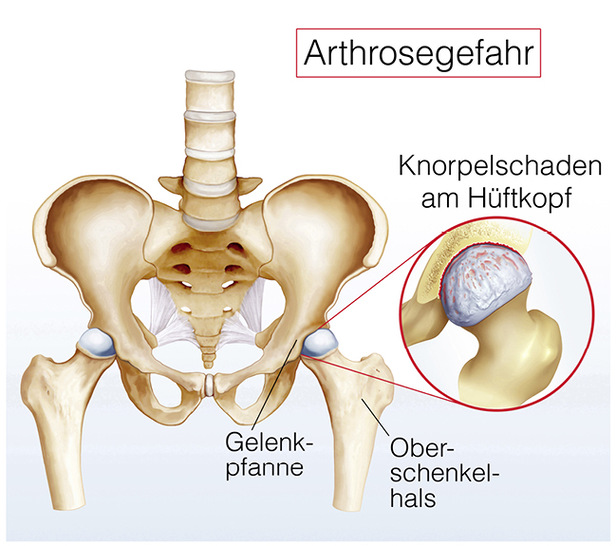 Abbildung Hüftgelenk - © Quelle: AdobeStock_75783637

