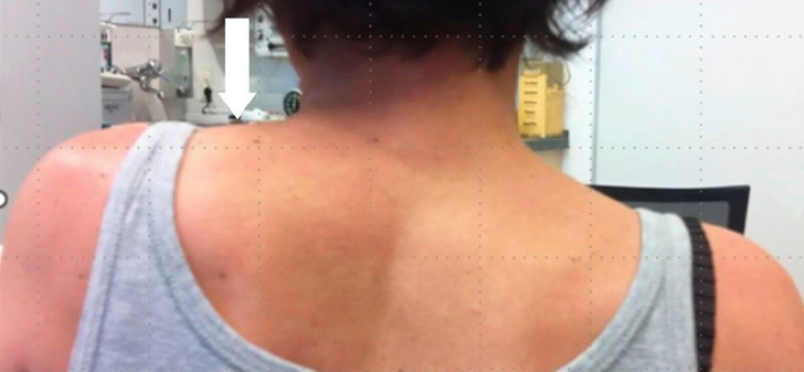 Abb. 1: Fixierter Schulterhochstand links (Pfeil) mit leichter Kippung des Kopfes nach links nach starken lokalen postoperativen Schmerzen bei karzinombedingter Neck-Dissektion mit Teilschädigung des N. akzessorius links.