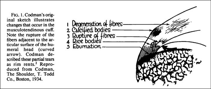 Abbildung 1. Codman-Klassifikation. Abbildung aus (Ellman, 1990)