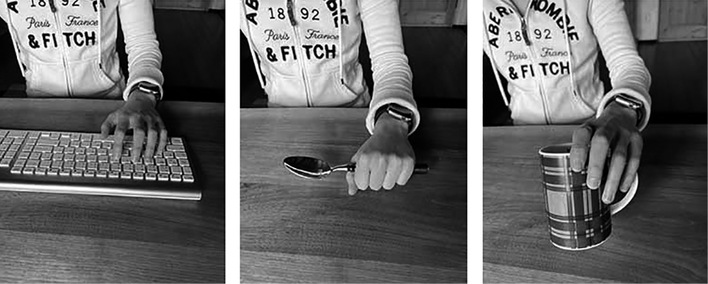 Abb. 1: Aufhebung der Unterarmdrehung in Pronation