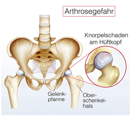  Abbildung Hüftgelenk